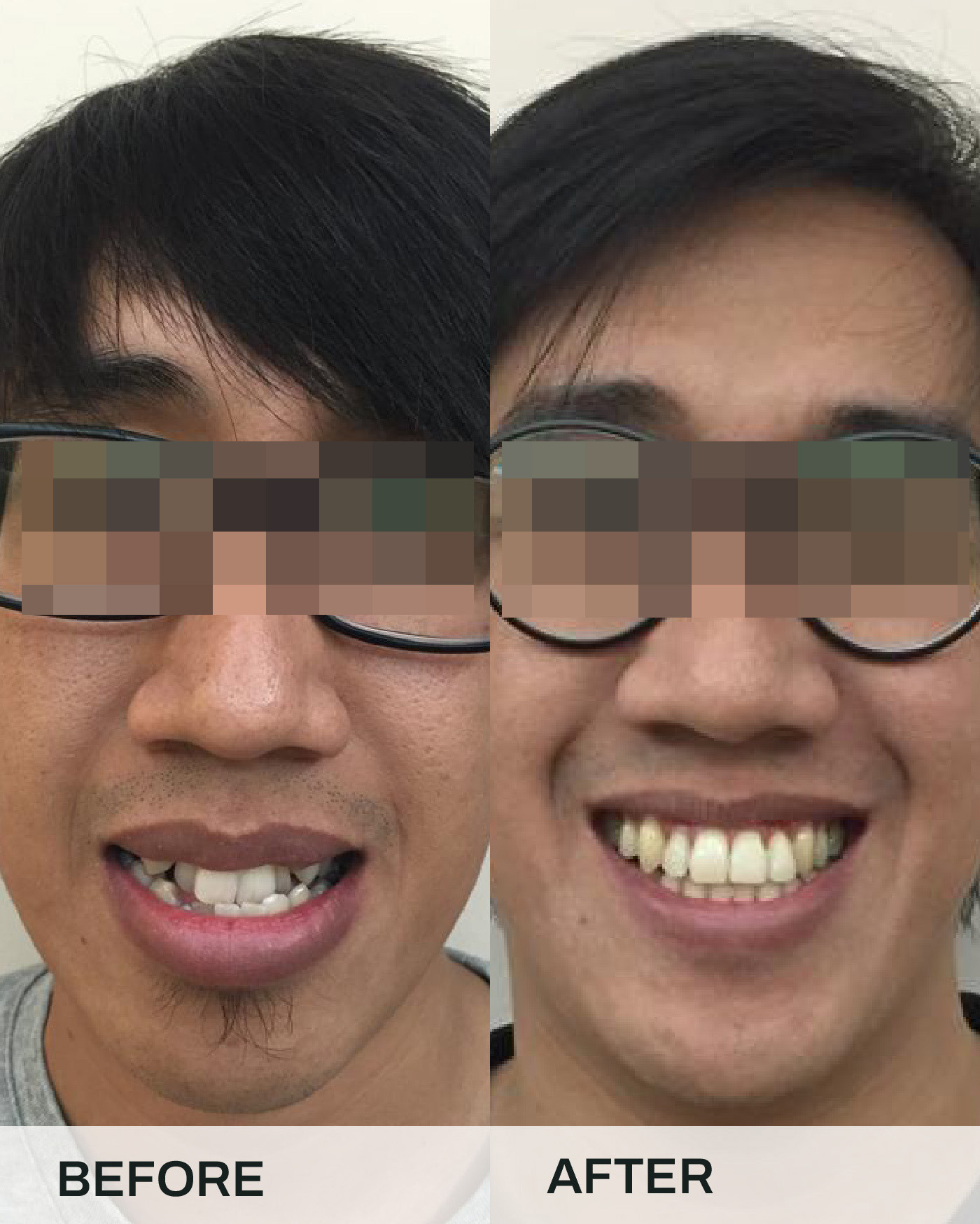 Before and after braces treatment, case 1, at iCare Dental IOI City Mall Putrajaya