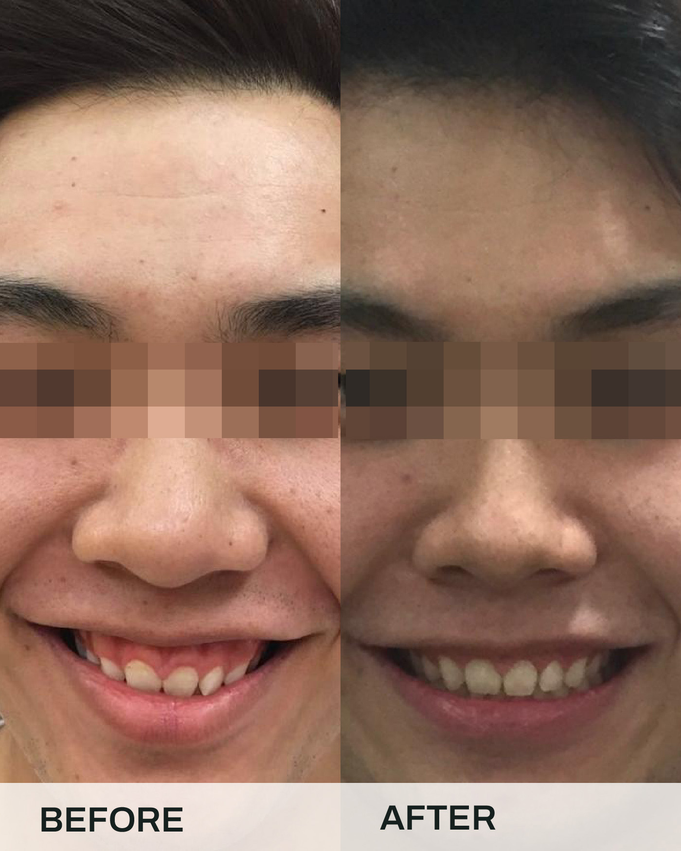 Before and after braces treatment, case 2, at iCare Dental IOI City Mall Putrajaya