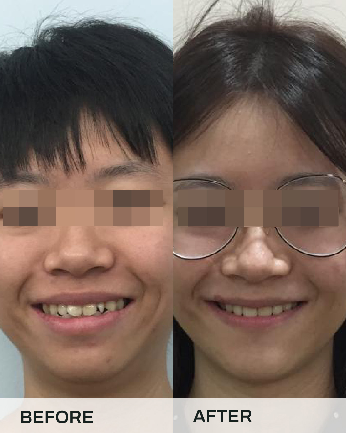 Before and after braces treatment, case 4, at iCare Dental IOI City Mall Putrajaya