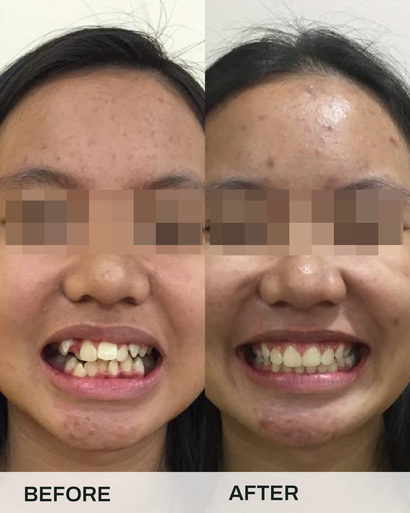 Before and after braces treatment, case 5, at iCare Dental IOI City Mall Putrajaya