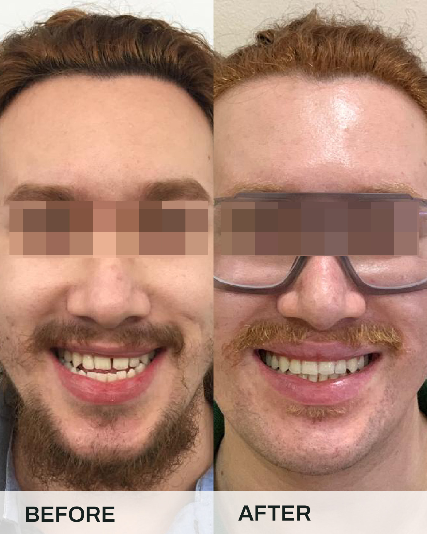 Before and after braces treatment, case 6, at iCare Dental IOI City Mall Putrajaya
