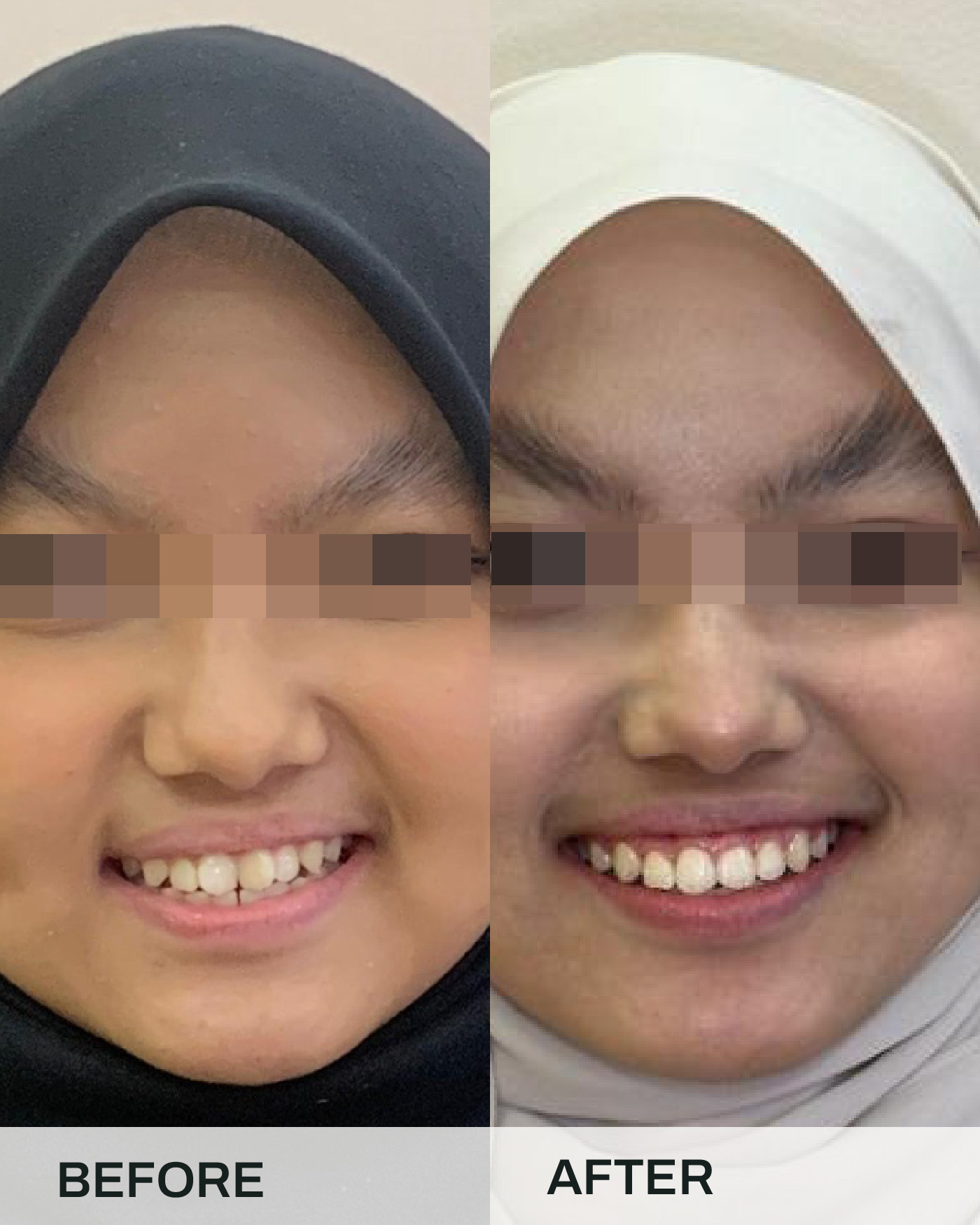 Before and after braces treatment, case 7, at iCare Dental IOI City Mall Putrajaya