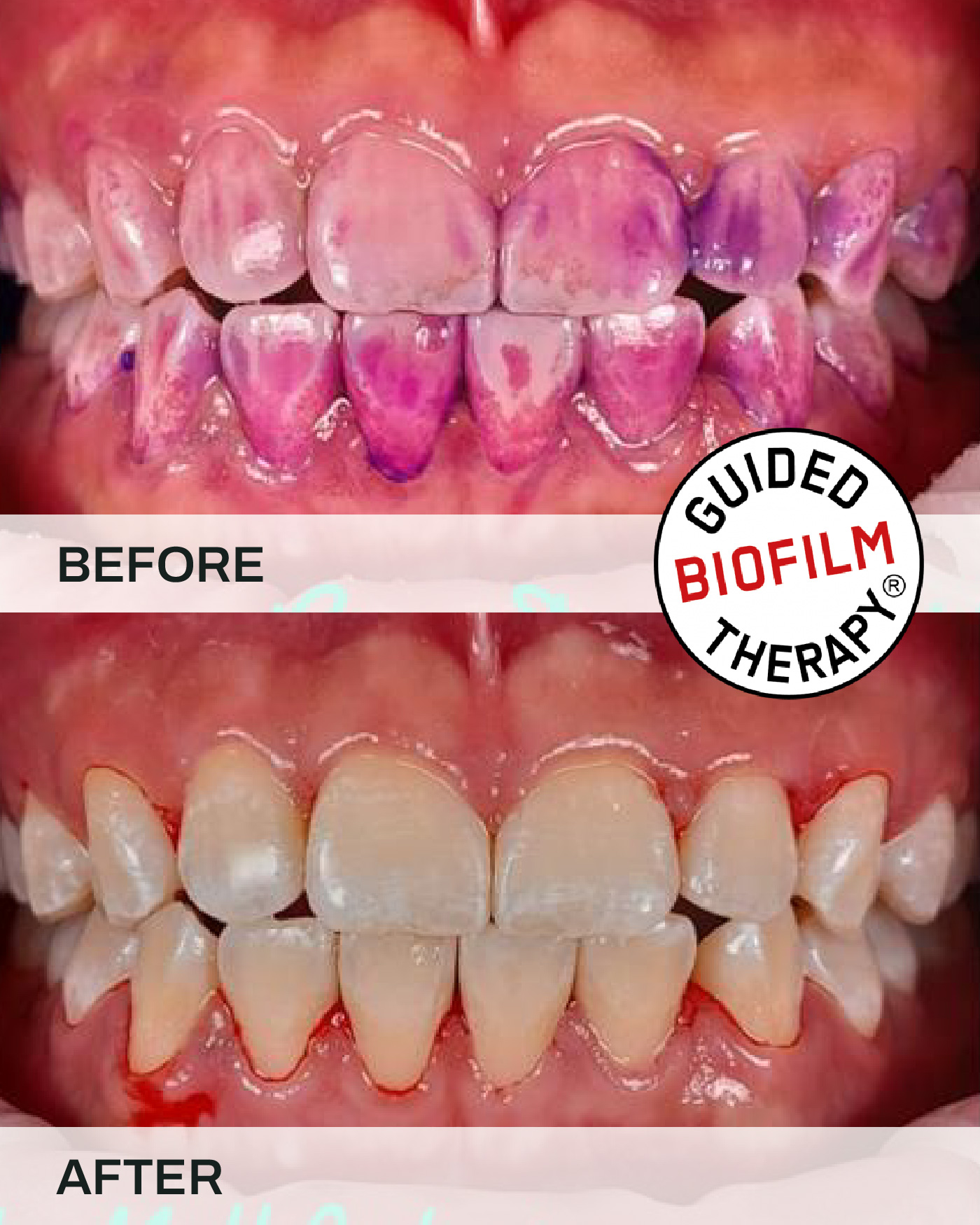 Before and after teeth scaling and cleaning, case 2, at iCare Dental IOI City Mall Putrajaya