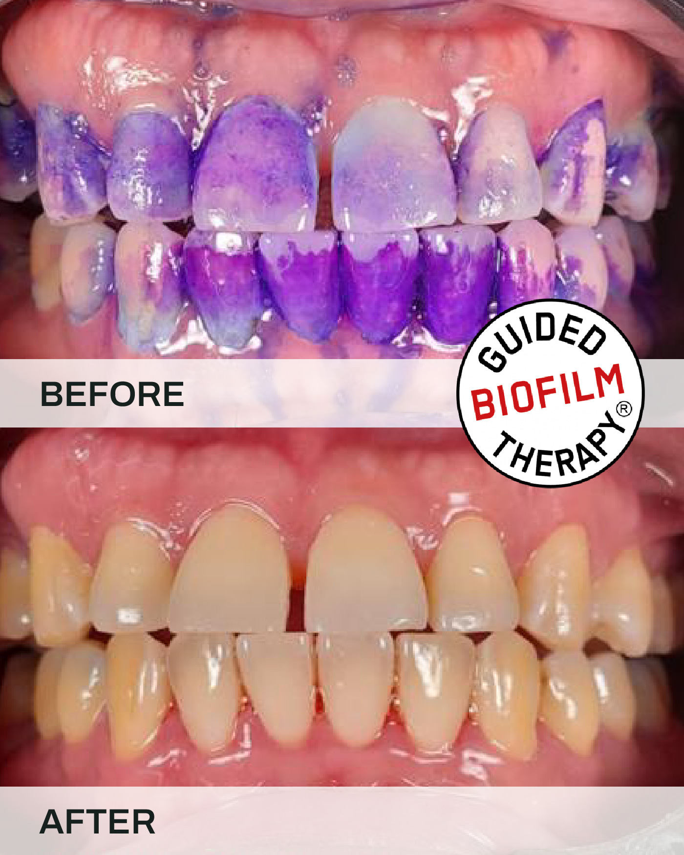 Before and after teeth scaling and cleaning, case 4, at iCare Dental IOI City Mall Putrajaya