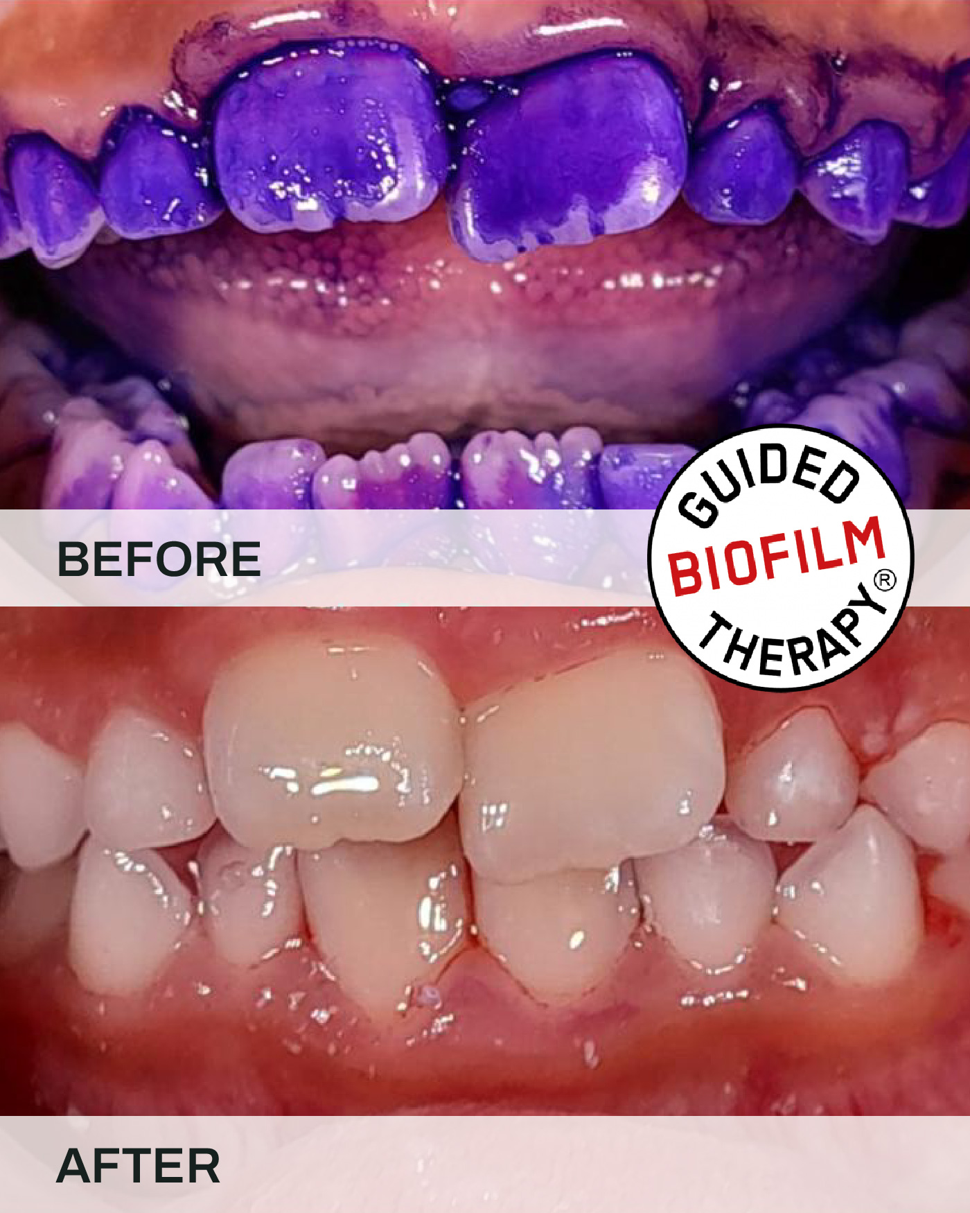 Before and after teeth scaling and cleaning, case 5, at iCare Dental IOI City Mall Putrajaya