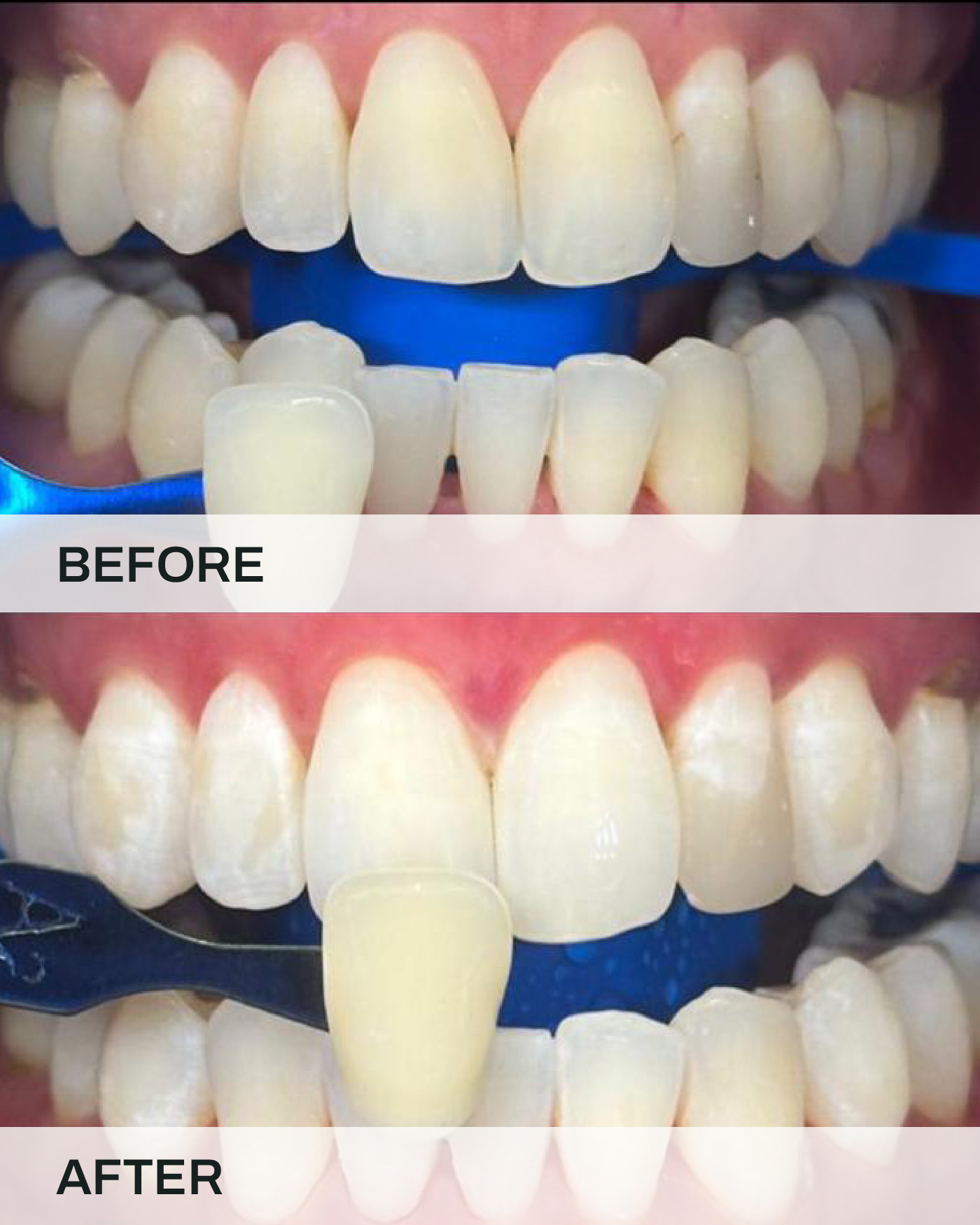 Before and after teeth whitening treatment at iCare Dental IOI City Mall Putrajaya